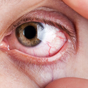 ¿Por qué revientan los vasos sanguíneos de los ojos?
