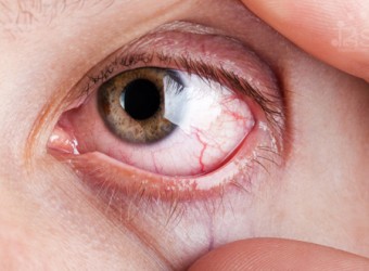 ¿Por qué revientan los vasos sanguíneos de los ojos?