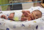 La fragilidad de los bebés prematuros