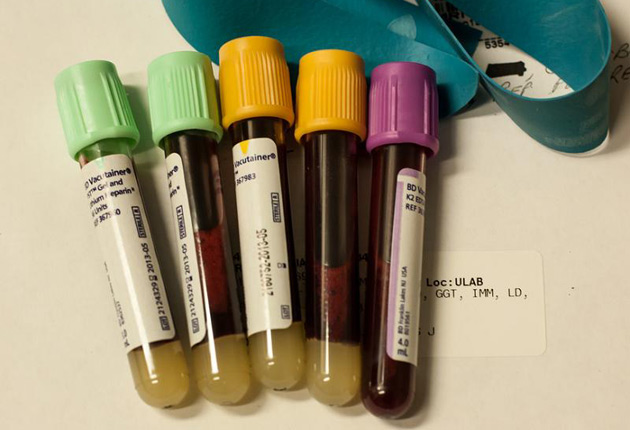 Desarrollan método para diagnosticar 13 tipos de cáncer con pruebas de sangre