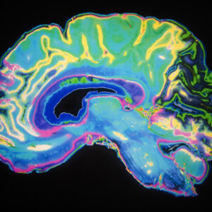 Las ondas cerebrales podrían ayudar a medir la gravedad del autismo, según un estudio