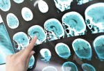 ‘Conviviendo con la esclerosis múltiple’, una guía pensada en la atención al paciente