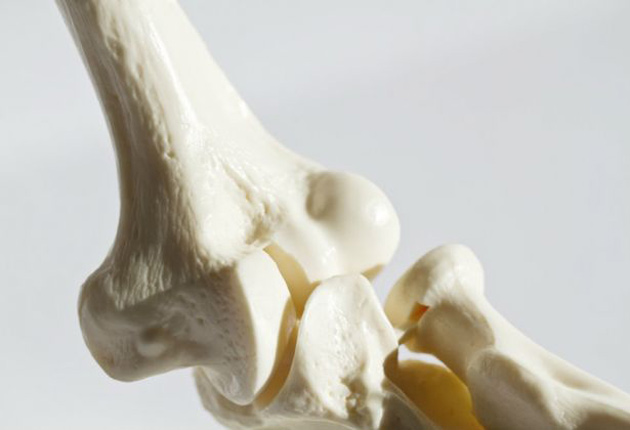 Osteoporosis: Los hombres son el sexo débil