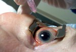 Células madre devuelven la vista a pacientes ciegos