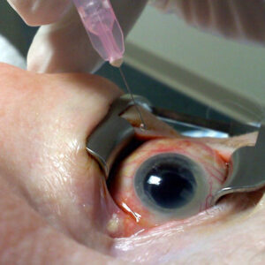 Células madre devuelven la vista a pacientes ciegos