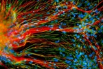 La terapia celular logra el control de la esclerosis múltiple a tres años