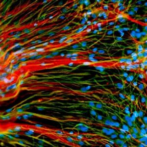 La terapia celular logra el control de la esclerosis múltiple a tres años