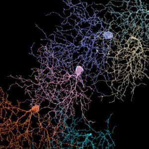 El mapa de conexiones entre neuronas en el cerebro de una persona con autismo