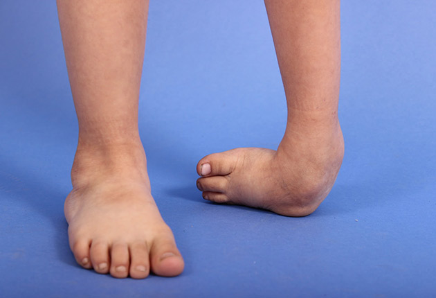 Pie equino en parálisis cerebral y equinismo funcional, la operación de Strayer