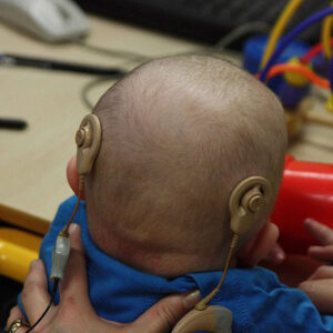 Implante coclear recupera audición en 90% de niños con sordera