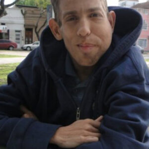 Le quitaron el subsidio por discapacidad al único argentino con síndrome de Proteus