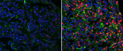 Organoides cerebrales formados por células madre de un paciente con autismo (derecha) contenían más proteínas (en rojo y verde) asociadas con un tipo específico de neurona que los organoides hechos de las células de su padre (izquierda).