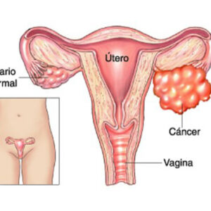 Cáncer de ovario