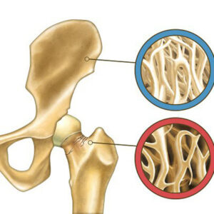 Osteoporosis.