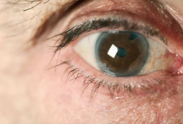 Cómo Prevenir El Glaucoma De Manera Natural Todos Somos Uno 5230