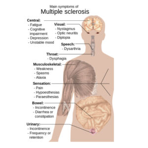 Esclerosis múltiple
