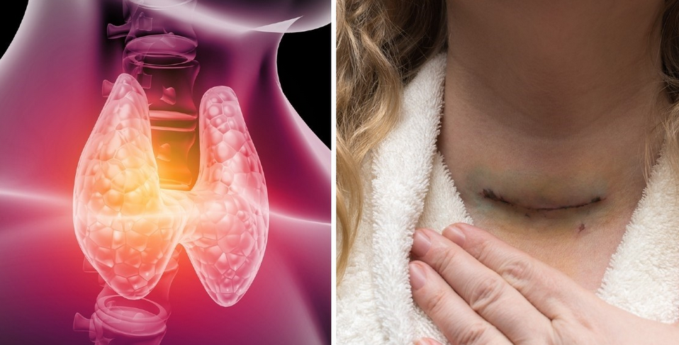 ¿Qué pasa si te quitan la tiroides? 4 casos en los que tu médico podría extirparla