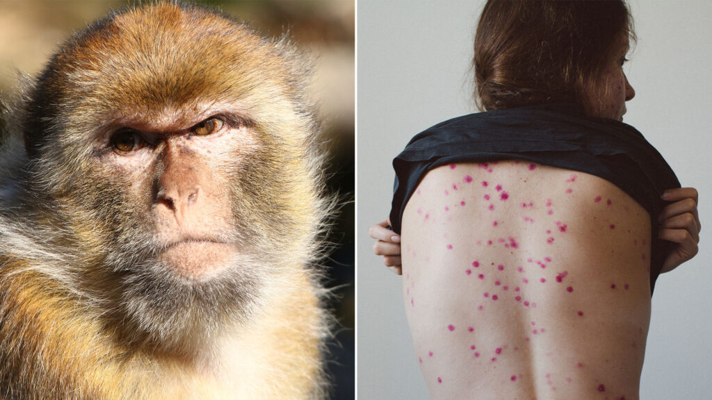 Viruela del mono: cómo se transmite, cuáles son los síntomas y qué hacer para evitar contagiarte