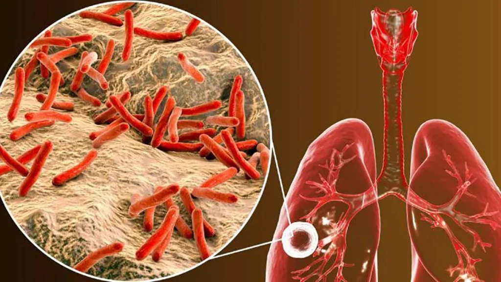 La Tuberculosis: Un Peligro Elevado en Personas con Enfermedades Autoinmunes